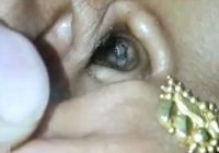 Horrifying Moment A Spider Crawls Out Of A Woman’s Ear