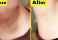 How to Get Rid of Dark Underarms Overnight with Grandma’s Secret