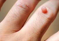 Common Warts Removal Tips, Home Remedies & Treatments