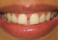 What Does The Gap Between Your Teeth Signify