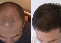 Simple and indigenous treatment of baldness