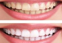 How to Whiten Teeth & Cure Tooth Cavities Home Remedies