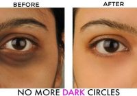 Dark circles under eyes home remedy