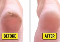Home Remedies to Get Rid of Cracked Heels