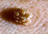 Get Rid of Moles, Warts, Black Spots