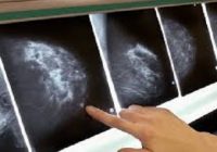 What is Breast Cancer Early Symptoms, Causes, and Treatment