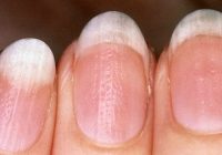 What Causes White Marks On Nails