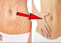 Stretch Marks Remove in 3 Days