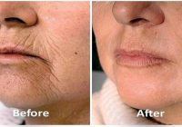 Remove Wrinkles Permanently ❤️ Skin Tightening Naturally