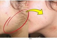 Remove Unwanted Hair Permanent At Home