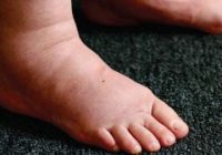 Swollen Ankles and Feet Symptoms, Causes and Treatment