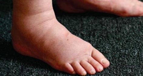 Swollen Ankles and Feet Symptoms, Causes and Treatment