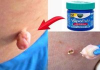 Home Remedies To Remove Skin Tags