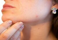 Easy and proven tips to get rid of facial pimples