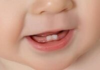 Teeth problems in children