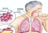 Cough, bronchitis. Complete information and treatment