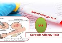 13 types of allergies and their treatment