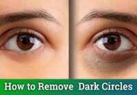 Treatment of circles around the eyes