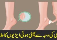 Treatment of cracked heels due to cold