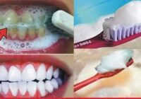 Tooth decay in two minutes, clear toothache and fine