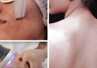 Treatment of facial pimples and body scars