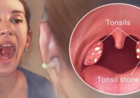 Treatment of tonsils without operation