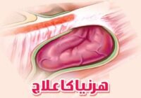 Treatment of hernia