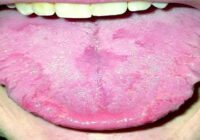 Tongue symptom treatment there are five types of tongue disease