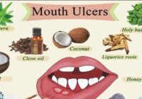 What Causes Mouth Ulcers and How to Treat Them