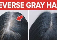 Premature graying of hair