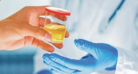 Yellow color of urine and burning sensation and jaundice of urine ...