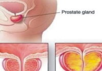 The human prostate gland shown in the picture below