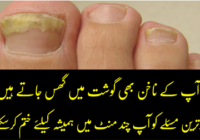 Get Rid of Fungal Nail with Home Remedies
