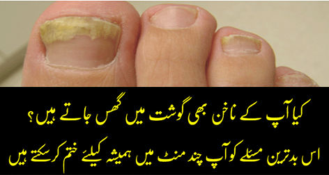 Get Rid of Fungal Nail with Home Remedies
