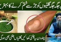Lipoma Treatment by Dr Sharafat Ali Gilti Ka Ilaj