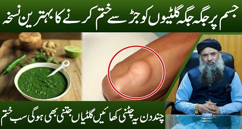 Lipoma Treatment by Dr Sharafat Ali Gilti Ka Ilaj