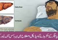 Causes and Symptoms of Liver Stiffness