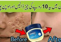 Get Rid of Large Pores Naturally