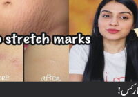 Stretch marks on the body after pregnancy