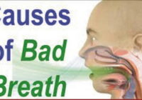 Treatment Of Bad Breath