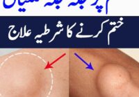 Symptoms and Treatment of Lipoma