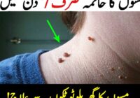 Warts on Hands and Feet: Effective Home Remedies