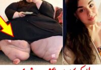The Operation of Noor Hasan, Who Weighs 330 kg, was Successful