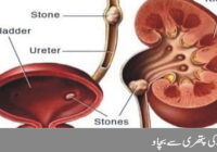 Prevent kidney stones