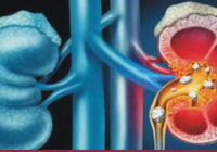 Your kidneys are responsible for removing toxins, dirty blood, excess salts from your body