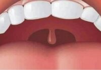 Swollen Uvula: Causes and Treatment for Uvulitis