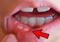 Excellent Remedy for Mouth Sores